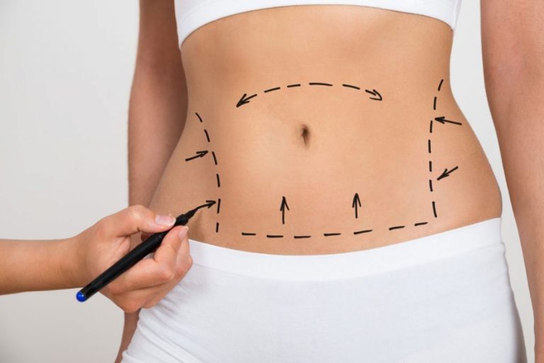 Aesthetic Medicine Treatments at Clinica Britannia: Abdominoplasty (Surgery of the Abdomen)
